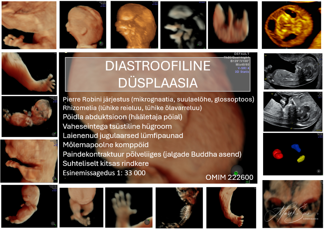 Diastroofiline düsplaasia