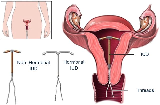 Intrauterine device