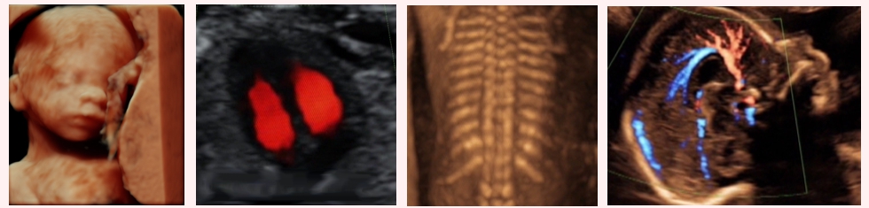 20 weeks pregnant ultrasound abnormalities