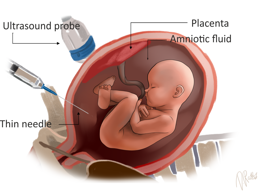 amniotic fluid test strip turns blue