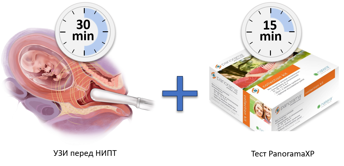 Pre-NIPT УЗИ вместе тест PanoramaXP