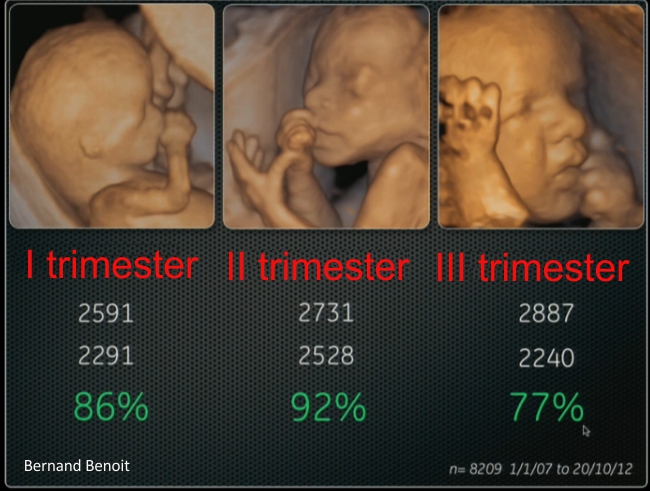 3d vs 4d vs hd ultrasound